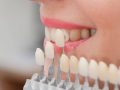 Cum putem preveni riscurile unui tratament cu fatete dentare incorect?