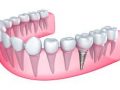 Care sunt riscurile amanarii implantului dentar?