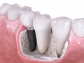 Ai un implant dentar? Iata cateva metode prin care poti sa asiguri durabilitatea
